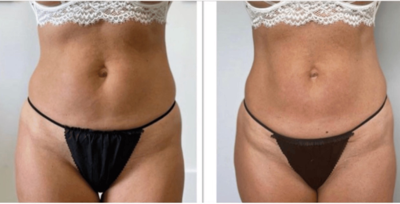 Ergebnis Bauch