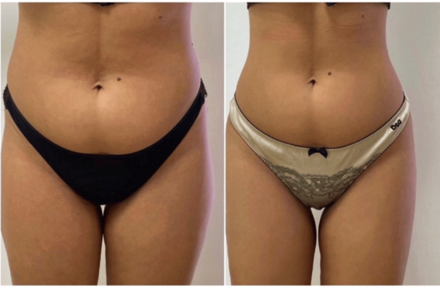 Ergebnis Bauch