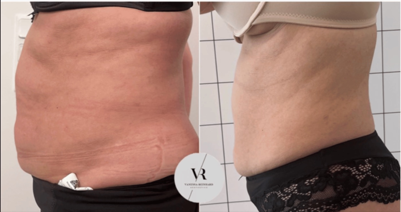 Ergebnis Bauch Seite
