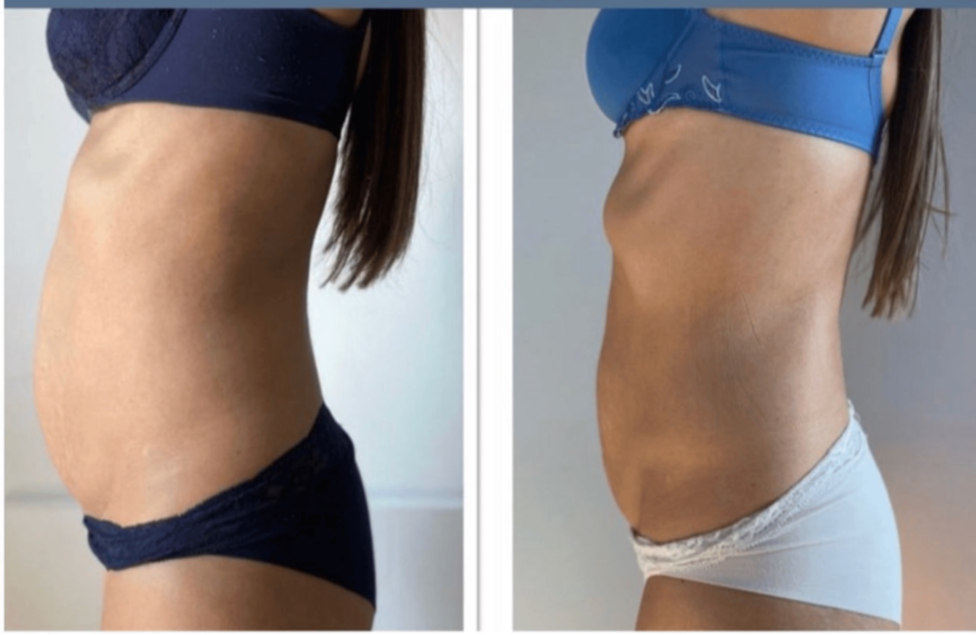 Ergebnis Bauch Seite